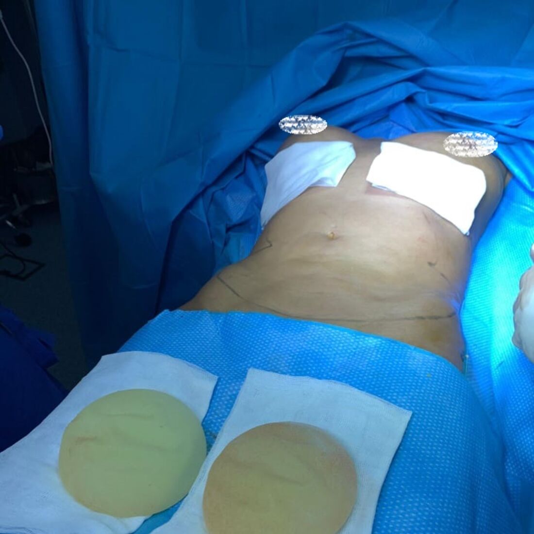 Érica Silva, casa dos segredos 4, tvi, cirurgia plástica, bloco operatório, José Moreira Martins