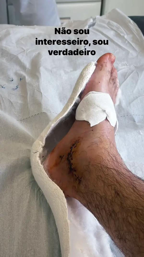 Diogo Carmona mostra o pé após cirurgia devido a lesão sofrida em Madrid